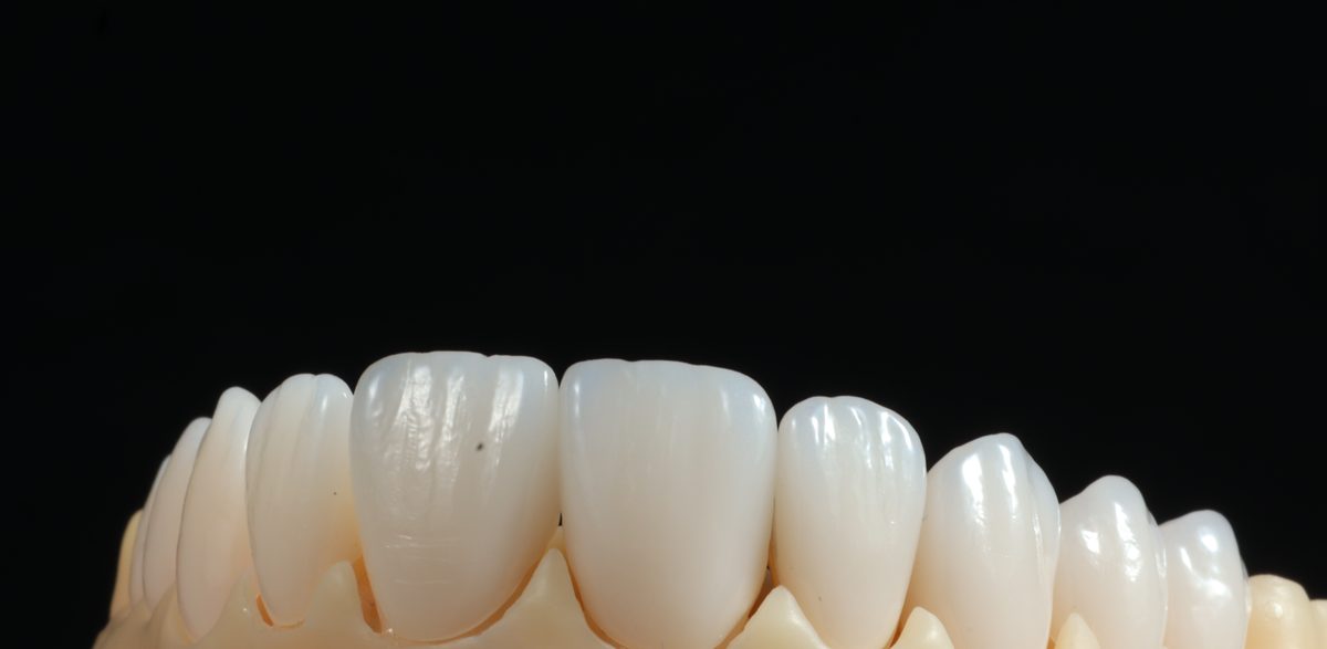 Facetas de porcelana produzidas no laboratório de prótese do CROOL